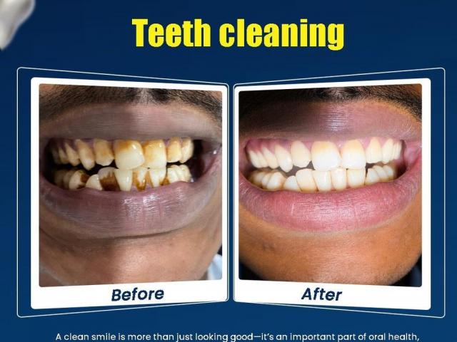 Teeth Cleaning In Hanamkonda And Warangal Looking For The Dentist Near Me Or A Trusted Dental